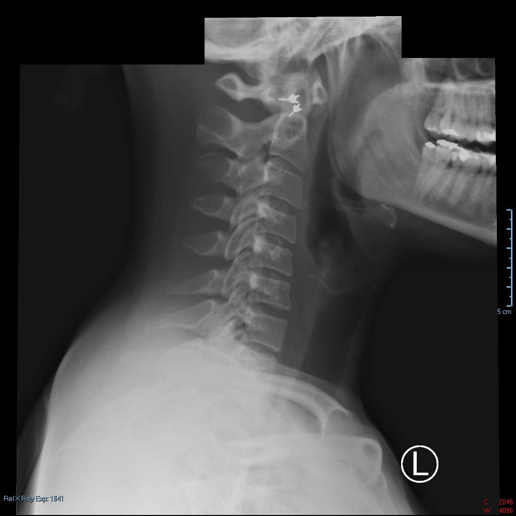 Digital Xrays for Chiropractic Treatment Chiropractor Orange CA